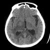 Lymphoma - Hình ảnh 5