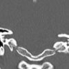 Cholesteatoma - Hình ảnh 5