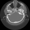 Cholesteatoma - Hình ảnh 5