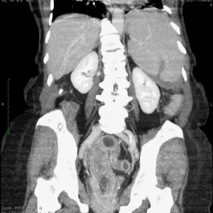 Chấn thương lách