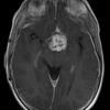 Glioma dưới đồi - Hình ảnh 5