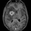 Lymphoma não - Hình ảnh 5