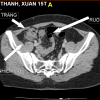 Viêm túi thừa - Hình ảnh 5