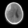 Thoát vị não - Hình ảnh 5