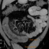 Crohn - Hình ảnh 4