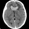 Lymphoma não - Hình ảnh 5