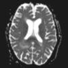 Lymphoma não - Hình ảnh 5