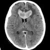 Lymphoma não - Hình ảnh 6