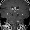 Lymphoma - Ảnh 6