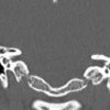 Cholesteatoma - Hình ảnh 6