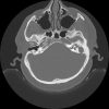 Cholesteatoma - Hình ảnh 6