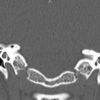 Cholesteatoma - Hình ảnh 7