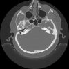 Cholesteatoma - Hình ảnh 7