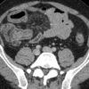 Crohn - Hình ảnh 2