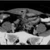 Crohn - Hình ảnh 8