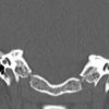 Cholesteatoma - Hình ảnh 8