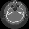 Cholesteatoma - Hình ảnh 8