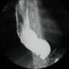 Achalasia - Hình ảnh 4