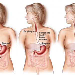 Phẫu thuật Ivor Lewis