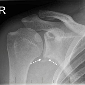 Chấn thương khớp vai