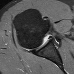 Chấn thương khớp vai