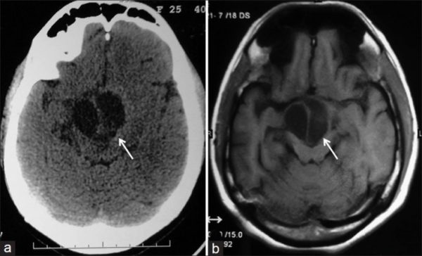 Glioma dưới đồi