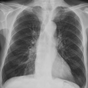 Túi thừa thực quản