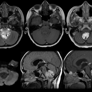 U nguyên bào mạch máu