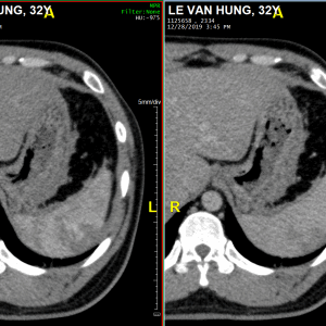 Chấn thương lách