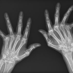 Viêm khớp dạng thấp