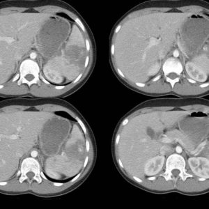 Chấn thương lách