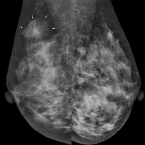 Hamartoma tuyến vú