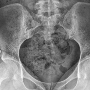 Dị dạng tử cung