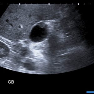 U cơ tuyến túi mật