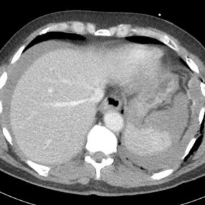 Chấn thương lách