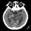 Lymphoma - Hình ảnh 6