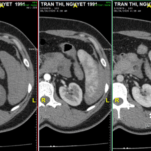 Chấn thương lách