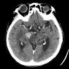 Lymphoma - Hình ảnh 7