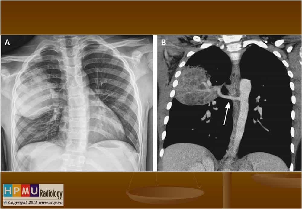CHỤP XQUANG GIÚP NHẬN DIỆN BẤT THƯỜNG Ở PHỔI BIỆT LẬP