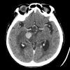 Lymphoma - Hình ảnh 8