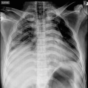 Chấn thương cơ hoành