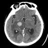 Lymphoma - Hình ảnh 9