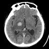 Lymphoma - Hình ảnh 10