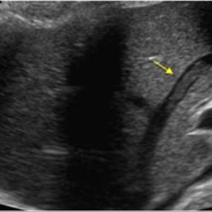 Huyết khối TM gan