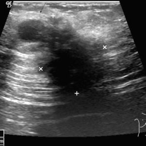 Lạc nội mạc tử cung