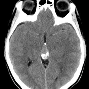 U vùng tuyến tùng