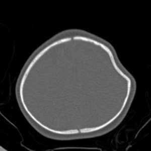 Vỡ xương hộp sọ