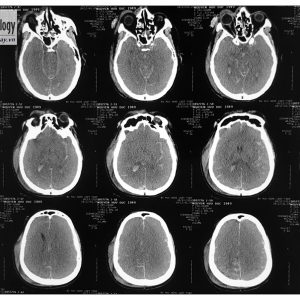 Vỡ xương nền sọ