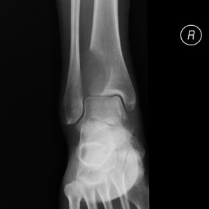 U tế bào khổng lồ