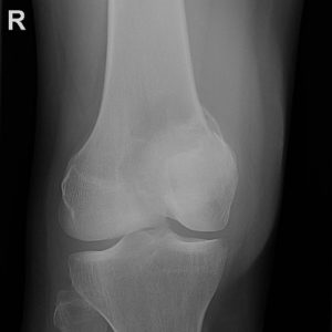 U tế bào khổng lồ